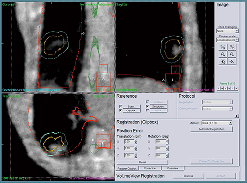 図2　3D-CT画像と4D-CBCTのレジストレーション