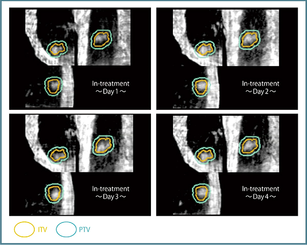 図4　VMAT中の4D-CBCTによる腫瘍の移動範囲の確認