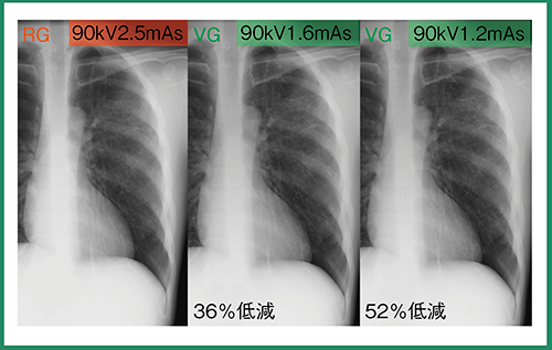図5　胸部ファントム画像による実グリッドとVirtual Gridの比較