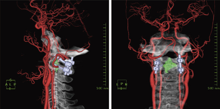 ボルト留置後の頸部腫瘍画像