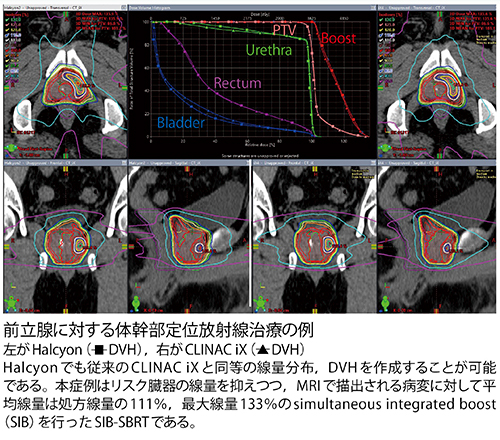 前立腺に対する体幹部定位放射線治療の例