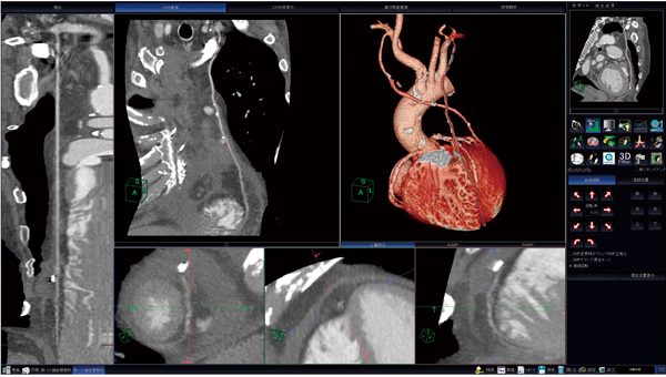 図1　CT細血管解析ソフトウェアによる冠動脈バイパスグラフト解析