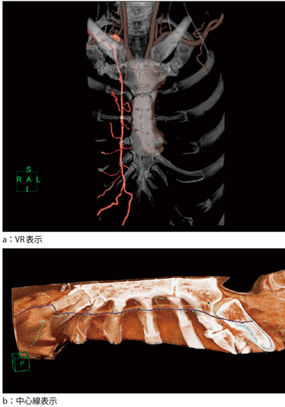 図3　内胸動脈の分枝検出