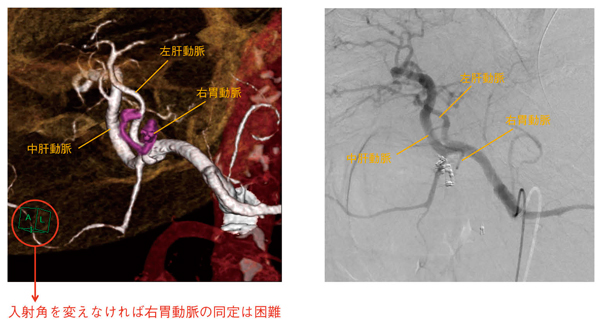 図3　実際の血管撮影との対比 左肝動脈から前方に分枝する変異した右胃動脈は，入射角を変えて初めて描出される。
