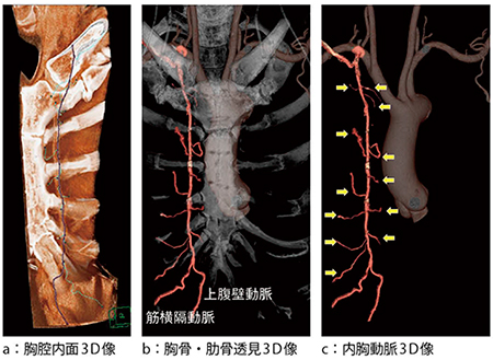 図2　内胸動脈の3D構築