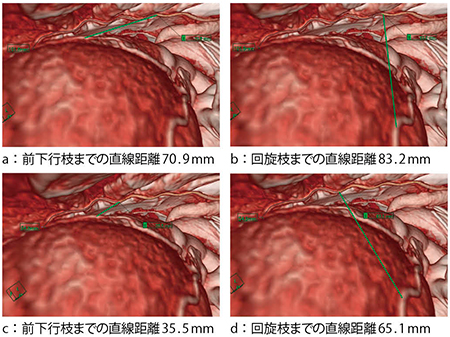 図4　内胸動脈の剥離範囲の算出 a，b：第2肋骨まで剥離した内胸動脈の長さは101.6mmであり，前下行枝も回旋枝も直線距離では到達可能である。 c，d：第4肋骨まで剥離した内胸動脈の長さは54.8mmであり，前下行枝までは直線距離で到達可能であるが，回旋枝までは到達不可能である。
