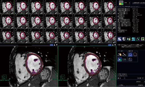 図1　“MRI心駆出率解析”による左心室機能解析
