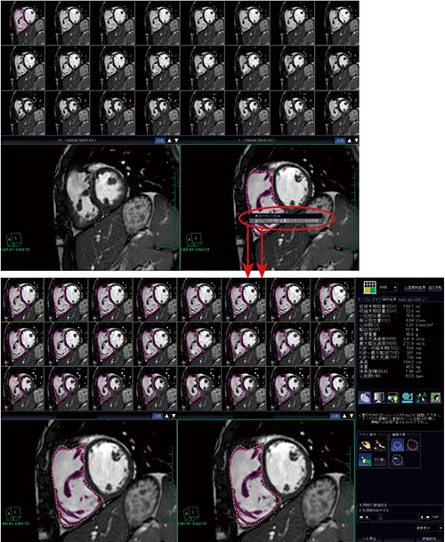 図2　“MRI右心室解析”による右心室機能解析