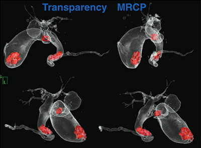 図2　transparency MRCP