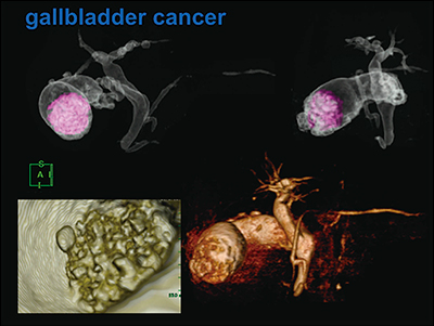 図4　胆嚢がん症例における3D MRCP