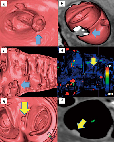 図4　仮想大腸展開画像：VGP