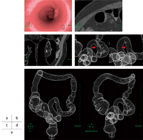 図6　Colitic cancerが疑われた患者の大腸CT検査 a：仮想内視鏡画像　b：アキシャル画像　c：コロナル画像 d：仮想注腸画像（→隆起性病変） e：仮想注腸画像（腹臥位）。隆起性病変付近の鉛管像と，上行結腸から下行結腸の粘膜変化が見られる。