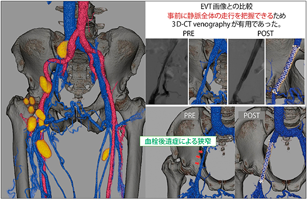 図3　PTS患者の下肢静脈狭窄に対するEVT支援画像（術前・術後）