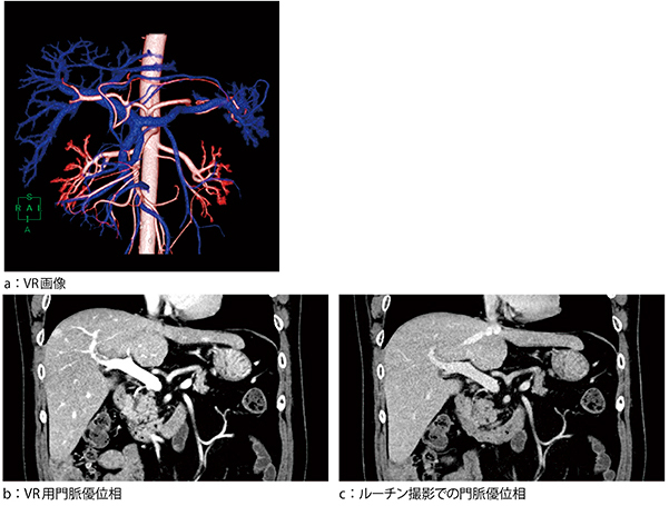 図1　術前の手術支援画像 a：動脈と門脈の走行および位置関係を描出 b，c：ルーチン撮影（c）と比べVR用撮影（b）では，門脈のCT値が上昇しているのが確認できる。 肝臓とのコントラストが明瞭なためVR画像作成が容易になった。