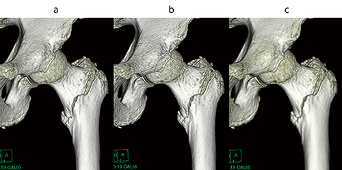 図5　大腿骨転子部骨折のVR画像 a：骨用関数 b：標準関数フィルタ適用（ガウスエッジ強調2Level＝3） c：標準関数