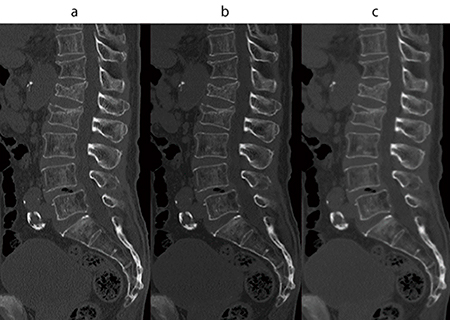 図6　腰椎圧迫骨折症例のMPR画像 a：骨用関数 b：標準関数フィルタ適用（ガウスエッジ強調2Level＝3） c：標準関数