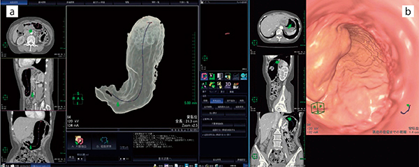 図1　大腸解析を用いた胃の仮想透視像（a）と仮想内視鏡像（b）