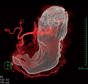 図2　仮想胃透視像と血管のフュージョン