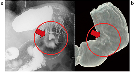 図4　症例1の胃透視像（a）と仮想胃透視像（b）