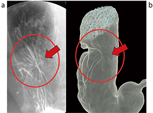 図7　症例2の胃透視像（a）と仮想胃透視像（b）