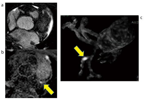 図6　症例2：プラMIPによる解析 症例2の冠動脈MRA（a），冠動脈プラークイメージングの元画像（b），プラMIP画像（c）。元画像（a，b）の対比のみでは，HIPの部位の特定は困難である。しかし，プラMIP画像で確認すると分枝血管のHIPであることが明白である。