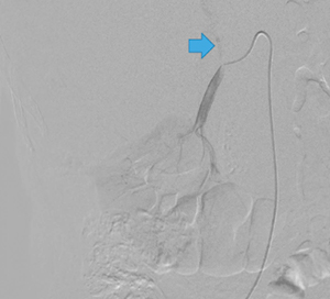 図2　右腎動脈の選択造影画像 右腎動脈のみ選択的に造影。腫瘍に向けて上行する細い血管あり（→）。