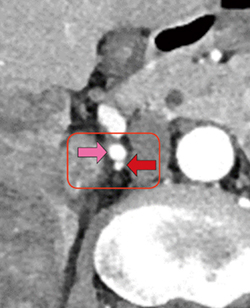 図9　造影CT早期相（図8の拡大像） 右腎動脈（→）　栄養血管（←） 腎動脈の後ろに，隙間なく接している。