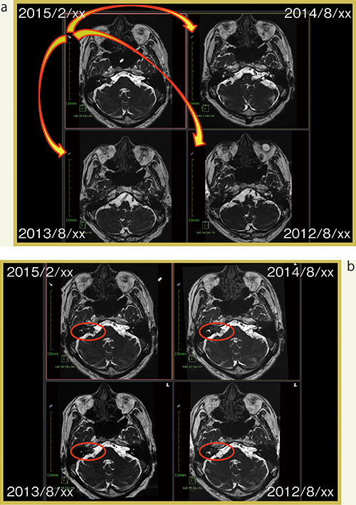 図3　AZE Phoenixのボリュームレジストレーション（聴神経腫瘍）