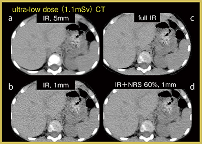 図2　低線量腹部CT（6歳，男児，1.1mSv）