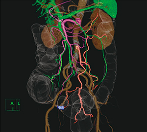 図1　大腸がんと下腸間膜動脈，門脈の血管解剖