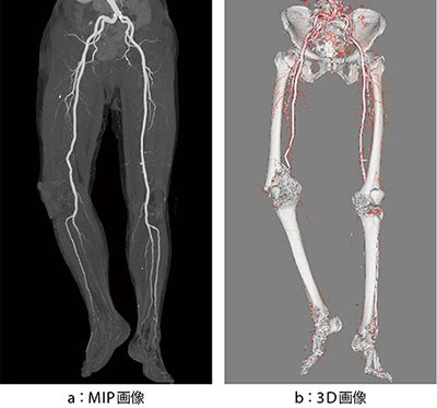 図1　外傷での全身撮影のCTA（動脈相、腹部〜足先） 右下肢〜足先の多発骨折に伴う、後脛骨動脈、腓骨動脈血流途絶を確認