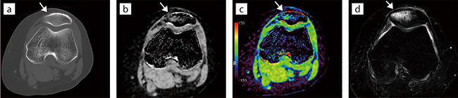 図2　膝蓋骨骨折（Dual Energy撮影） a：CT骨条件画像　b：CTカルシウム抑制画像（白黒）　c：CTカルシウム抑制画像（カラー）　d：MRI  T2脂肪抑制画像 CTの骨条件の画像だけでは不顕性であったが、Dual Energyのカルシウム抑制画像（BBI）により血腫の有無、広がりが評価できた。また、MRIのT2脂肪抑制画像ともよく類似しており、MRIをすぐに撮像できない環境下では骨折評価に有用だと考えている。