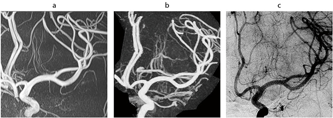 図1　高分解能MRA、高分解能CTA、DSAによるレンズ核線条体動脈（LSA）の描出能の比較（60歳代、女性） a：高分解能MRA　b：高分解能CTA　c：DSA