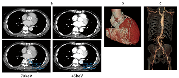 症例2　大動脈弁狭窄症（心臓Volume Scan+Spectral Scan） 経カテーテル大動脈弁留置術（TAVI）術前の計測、アクセスルートの確認目的。eGFRが23と腎機能が悪く、造影剤を極力減らした検査が求められた。造影剤は40mLで、Volume Scan＋Spectral Scanで撮影した。大動脈3D画像（c）はCT値を上昇させるため45keVの画像を使用したが十分評価可能であった。