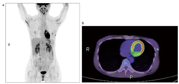 図1　左乳がん（T1N0M0） a　MIP画像　b　fusion（axial）画像 左乳房3時方向に最大径5.0mmの結節を認め、SUVmax＝8.7の集積を呈している。