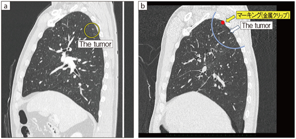 図2　胸腔鏡下肺切除術における術中CT a：術前の通常CTによる撮影　b：術中CT画像