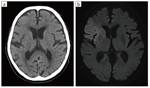 図1　急性期脳梗塞症例 a：CT ONE Volume scan　b：MRI DWI 80歳代、男性、脳卒中疑いで救急搬送、CT（a）では異常所見の確実な指摘は難しく、MRIを施行したところDWI（b）で右側頭葉に高信号が認められた。t-PA投与とヘリ搬送の適用ありと判断した。