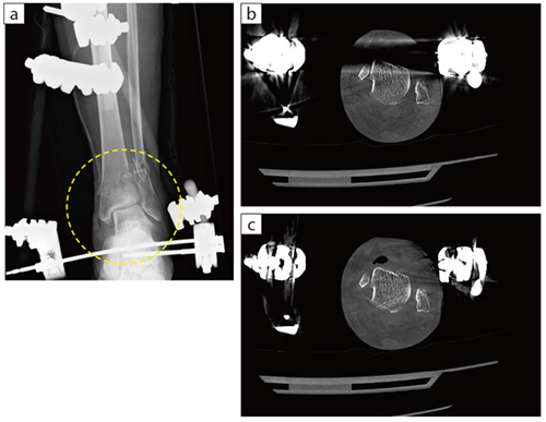 図2　左足関節　創外固定 a：Xray　b：SEMARなし　c：SEMARあり 80歳代、女性、左脛骨腓骨開放骨折の創外固定術後にCTを撮影。ダークバンドアーチファクトがSEMARで取り除かれている。