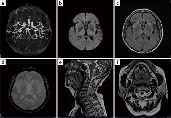 図1　頭頸部のルーチン撮像 a：MRA　b：DWI　c：FLAIR d：T2＊強調　e：T2強調（サジタル）f：T2強調（アキシャル） 手のしびれなどの症状がある場合は、約10分の撮像時間で頭部・頸椎の検査が可能