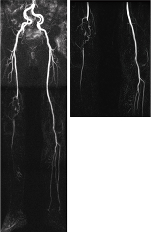 図2　下肢非造影MRA 歩行時、右下肢のしびれが出現。下肢MRAで膝窩動脈以遠の描出不良あり。他院循環器科にてPTAが実施された。