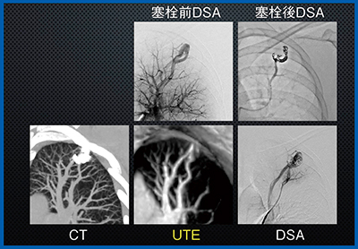 図6　UTEによる肺動静脈奇形のコイル塞栓術後評価