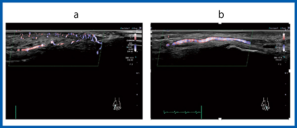 図2　Aplio i-seriesでのレイノー現象の評価 a：患指　b：健指 SMIを用いることで側副血行路を描出できる。