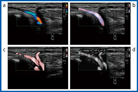 図3　PLI-705BXによるSMIとカラードプラ，ADFでの足背動脈の評価 a：カラードプラ　b：ADF c：cSMI（color-coded SMI）　d：SMI