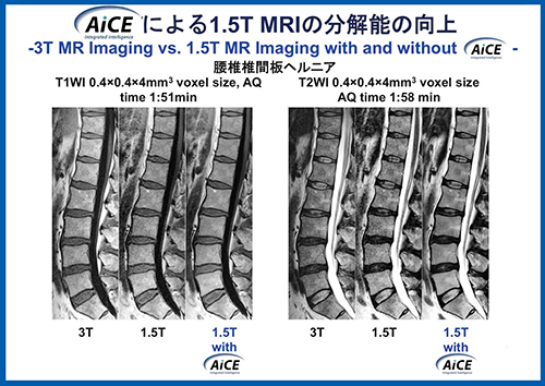 図4　腰椎椎間板ヘルニアにおけるAiCEによる1.5T MRIの分解能の向上