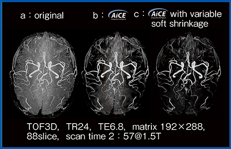 図3　Variable soft shrinkage によるSPEEDER由来ノイズの低減：頭部MRA