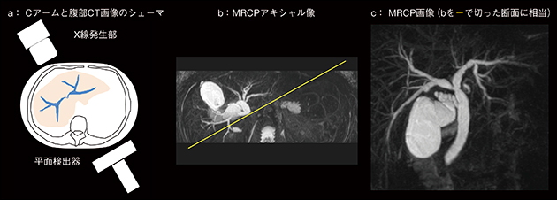 図2　Cアームの回転とMRCP画像の対比