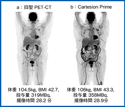図3　Cartesion Primeによる高体重患者の画質改善