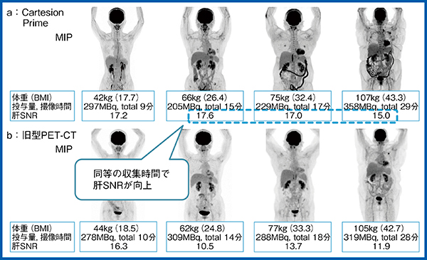 図6　体重の異なる4症例におけるCartesion Primeと旧型PET-CTの比較