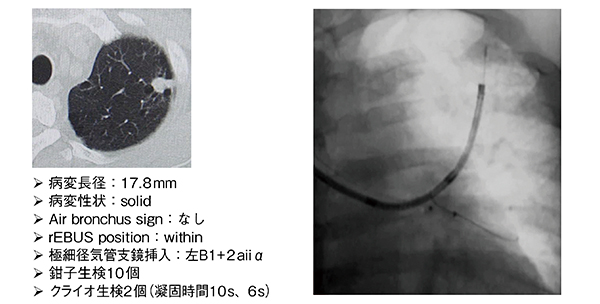 図9　症例：肺がん患者の極細径気管支鏡を用いたrEBUS下クライオバイオプシー（64歳、男性）