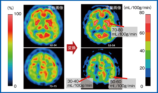 図3　定性画像から局所脳血流画像を作成し定量化